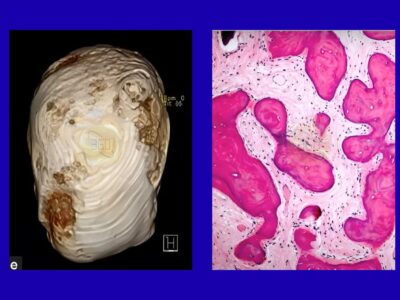 Fibro-Osseous Lesions: From Diagnosis to Clinical Management