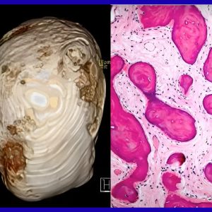 Fibro-Osseous Lesions: From Diagnosis to Clinical Management- Free content (Paid certificate)