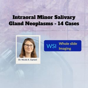 The Diagnostic Table: SLIDE360- Intraoral Minor Salivary Gland Neoplasms